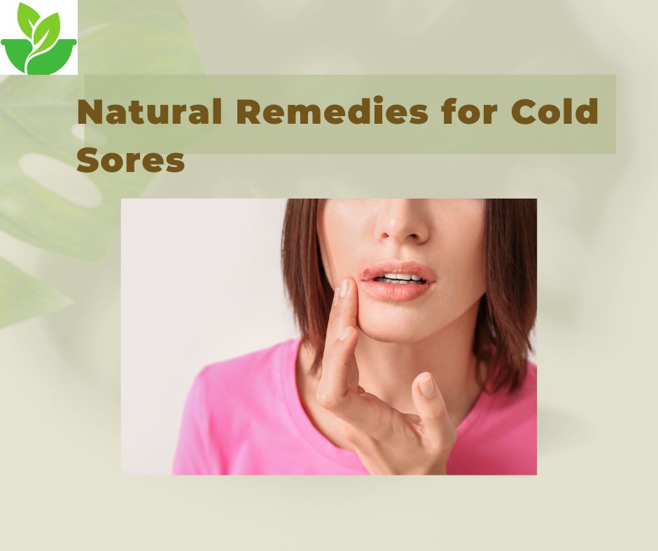 Natural Remedies for Cold Sores